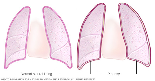 Normal pleural lining and pleurisy