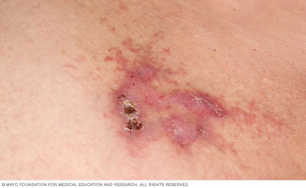Angiosarcoma that affects the skin