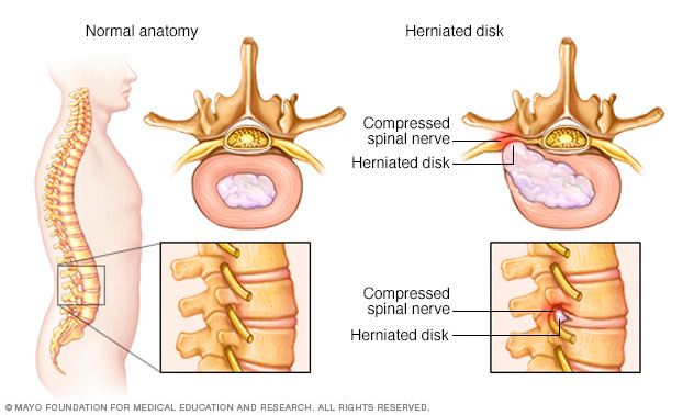 Herniated spinal disk