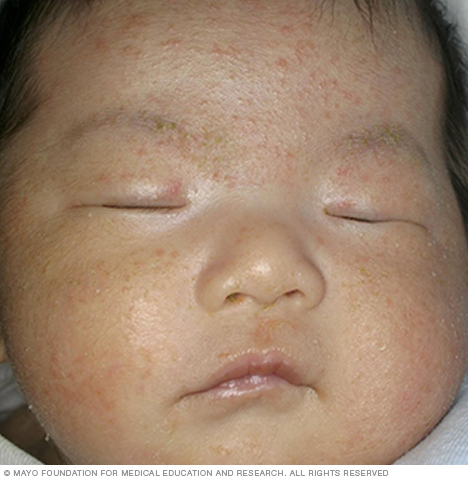 Image of baby acne
