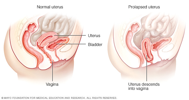 Normal uterus and prolapsed uterus