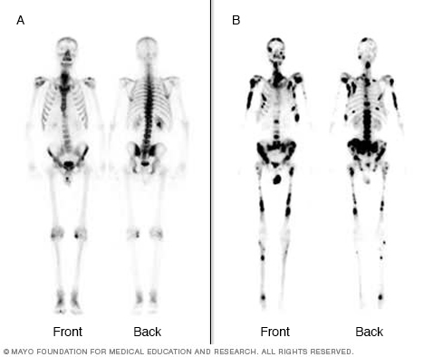 Images of bone scans depicting hot spots