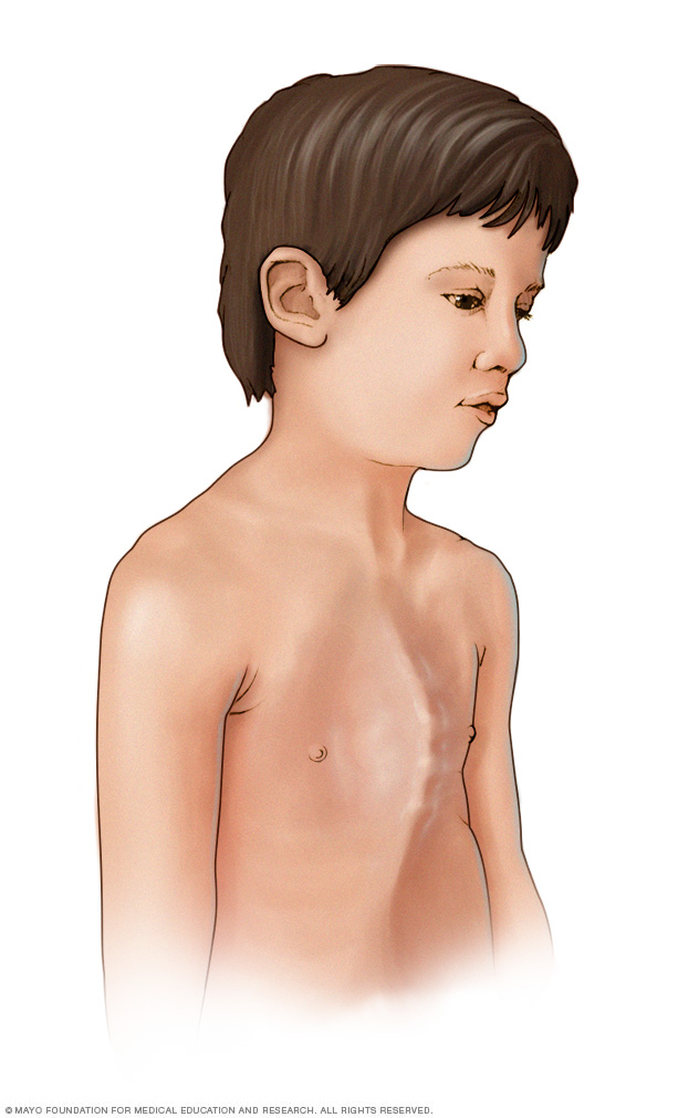Child with protruding breastbone