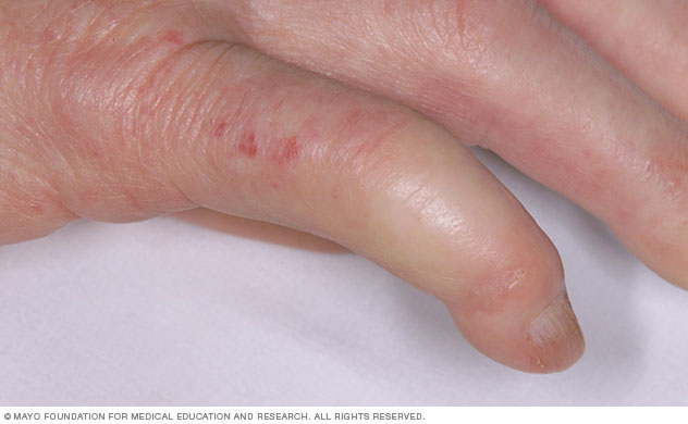 Finger affected by limited scleroderma 