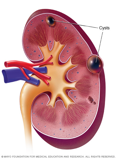 Kidney cyst 