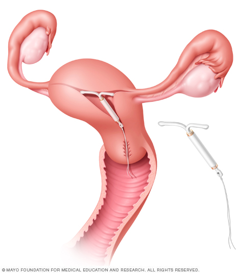 Illustration showing Mirena in place in the uterus