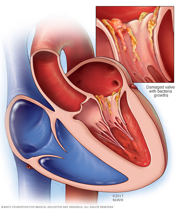 Effects of endocarditis on the heart